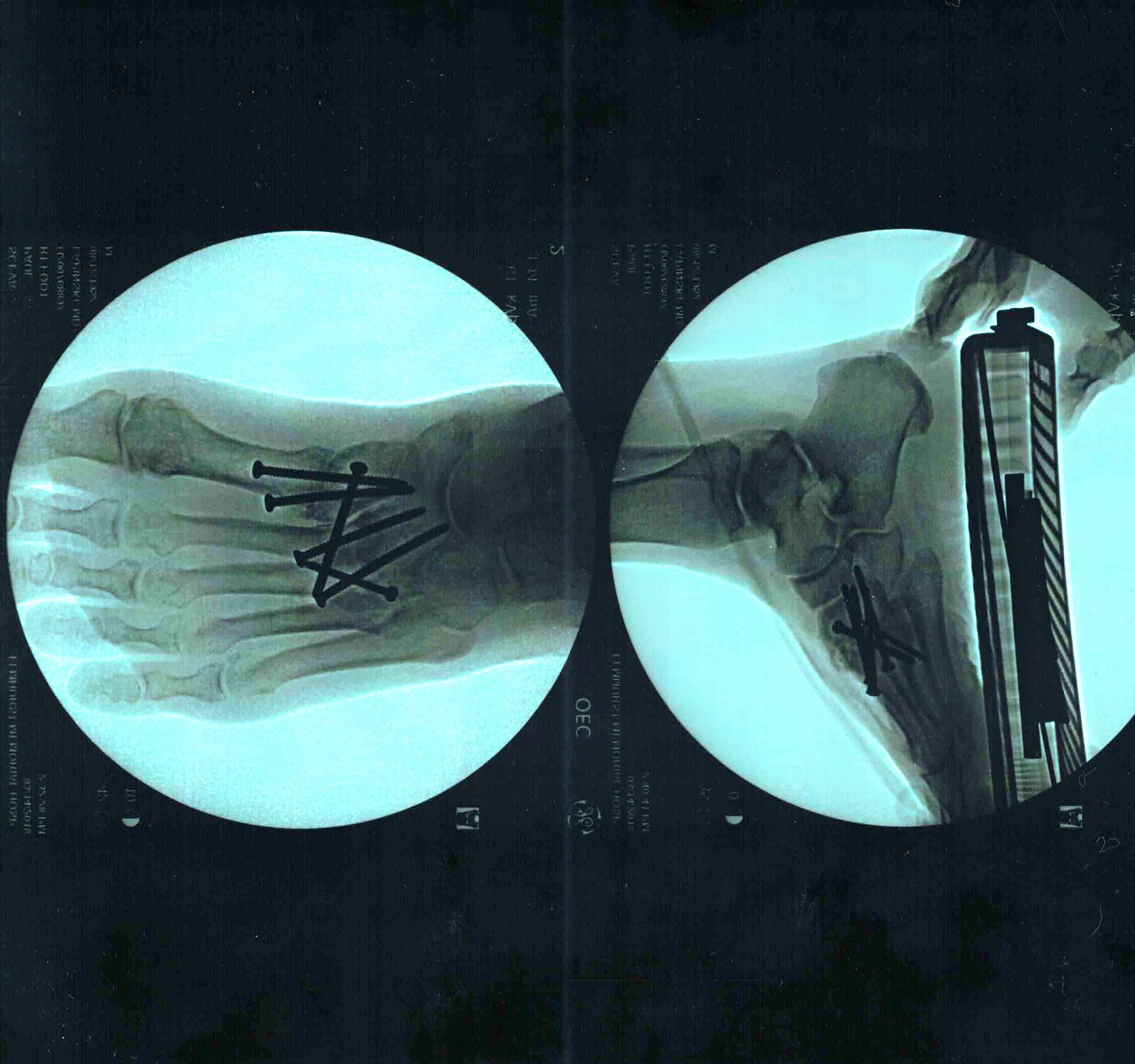 Foot X-ray.jpg