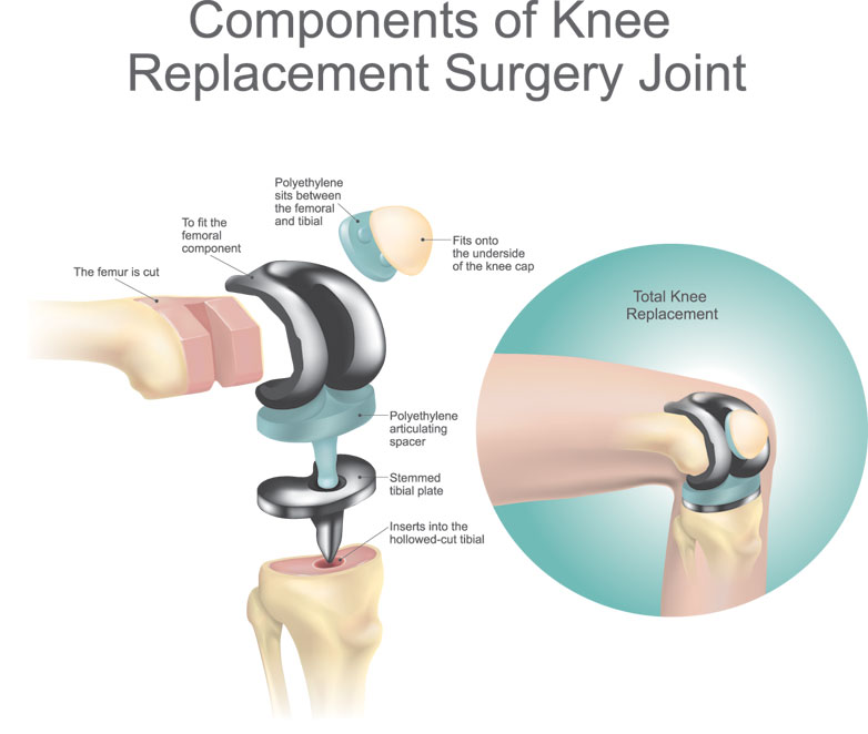 knee-replacement.jpg